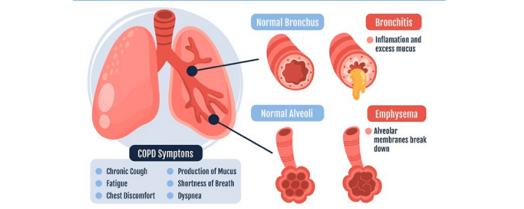 Chronic Obstructive Pulmonary Disease