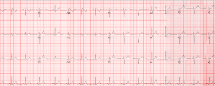 Electrocardiogram ECG