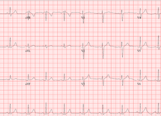 Electrocardiogram