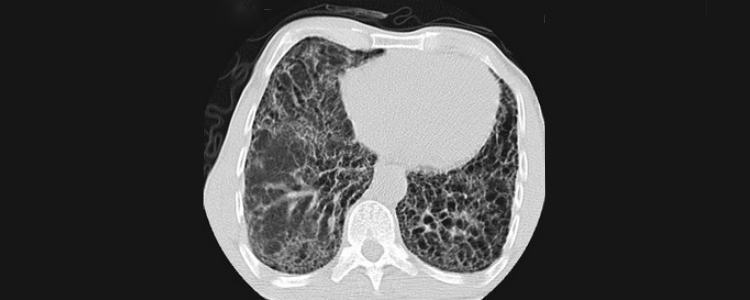 Interstitial Lung Diseases