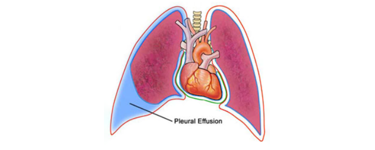 Pleural Effusion