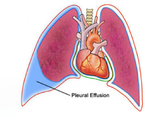 Pleural Effusion