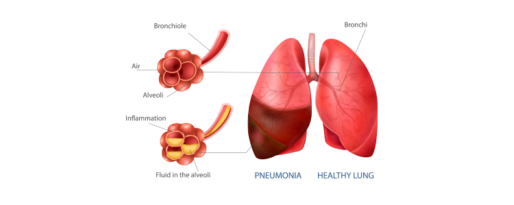 Pneumonia Treatment