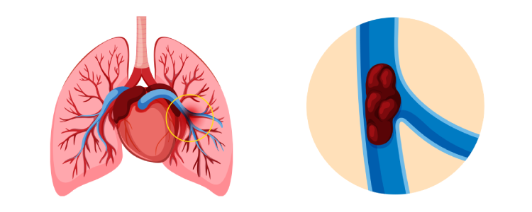 Pulmonary Embolism