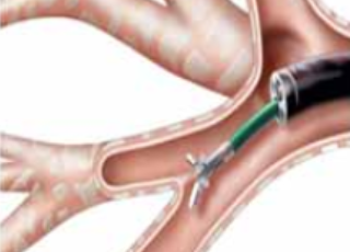 Interventional Pulmonology Procedures