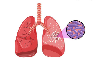 Tuberculosis Treatments