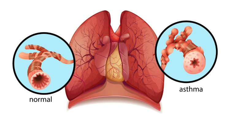 What is Asthma